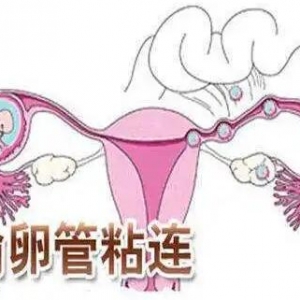 输卵管不通畅会怀孕吗?输卵管阻塞的原因有哪些？